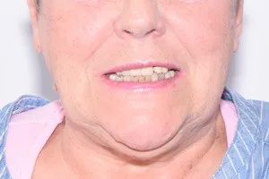 Восстановление зубов на безкаркасных протезах, фото до