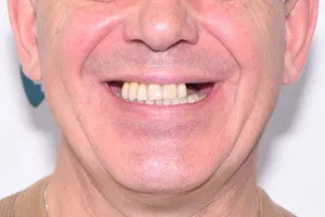 All-on-4 с имплантами Zygoma для верхней челюсти, фото до