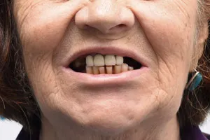 Восстановление обеих челюстей с применением имплантов Zygoma, фото до