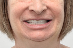 All-on-4 для новых зубов. Nobel Zygoma для верхней челюсти, фото после