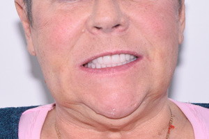 Восстановление зубов на безкаркасных протезах, фото после
