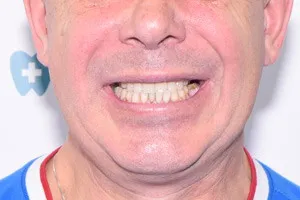 All-on-4 с имплантами Zygoma для верхней челюсти, фото после