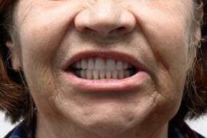 Восстановление обеих челюстей с применением имплантов Zygoma, фото до