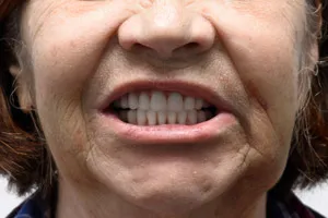 Восстановление обеих челюстей с применением имплантов Zygoma, фото после