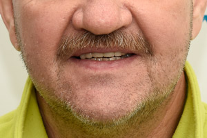 Новые зубы для верхней челюсти за 3 дня на имплантах Zygoma , фото после
