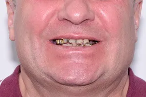 All-on-4 на замену старым зубам для верхней и нижней челюсти, фото до
