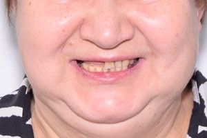 Импланты Nobel и новые зубы, фото до