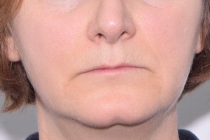 Протезирование All-on-4 верхней челюсти и виниры для нижней челюсти, фото до