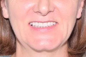 Протезирование All-on-4 верхней челюсти и виниры для нижней челюсти, фото после