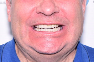 All-on-4 на замену старым зубам для верхней и нижней челюсти, фото после