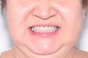 Импланты Nobel и новые зубы, фото после