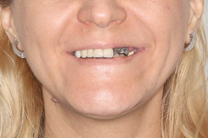 Все-на-4 для верхней и нижней челюсти. Импланты Nobel Zygoma, фото до