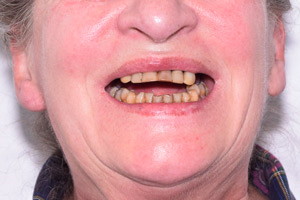 Все-на-4 с имплантами Zygoma для верхней челюсти, фото до