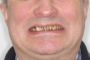 Все-на-4 с зигоматическими имплантами для верхней челюсти, фото до