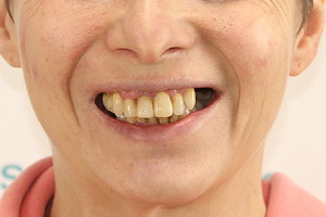 Восстановление зубов на обеих челюстях по протоколу All-on-4, фото до