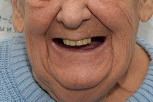 Новые зубы для пациентки 78 лет, фото до