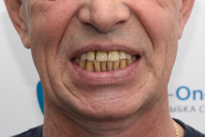 Зубы за 1 день на обе челюсти, фото до