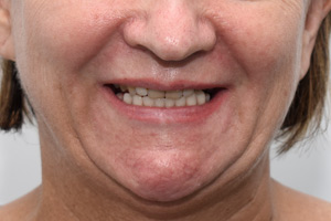 Зубы на нижней челюсти за 3 дня, фото до