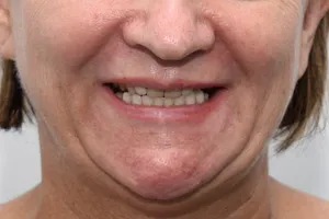Зубы на нижней челюсти за 3 дня, фото после