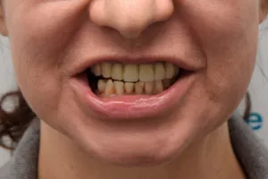 All-on-4 для верхней челюсти и три импланта для жевательных зубов, фото до