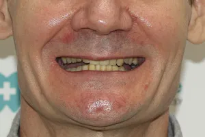 Новые зубы за 1 день для обеих челюстей, фото до