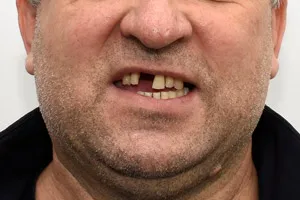Новые зубы на верхней и нижней челюстях за 1 день , фото до