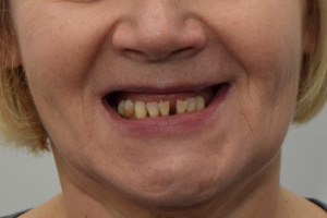 All-on-4 на замену съемному протезу и проблемным зубам, фото до
