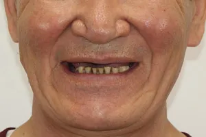 All-on-4 на обе челюсти для пациента из Якутии, фото до