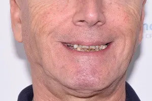 Новые зубы для пациента из г.Нальчик, фото до