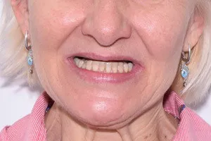 Все-на-4 с отсроченной нагрузкой для восстановления зубов верхней челюсти, фото до