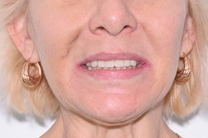 Все-на-4 с отсроченной нагрузкой для восстановления зубов верхней челюсти, фото после