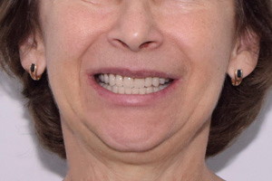 Протезирование обеих челюстей по протолу All-on-4, фото после