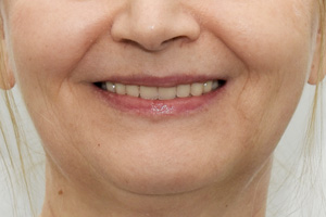 Зубы на нижней челюсти за 1 день и съемный протез для верхней, фото после