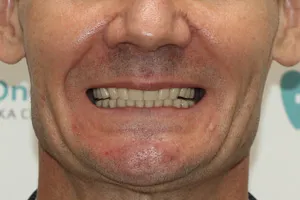 Новые зубы за 1 день для обеих челюстей, фото после