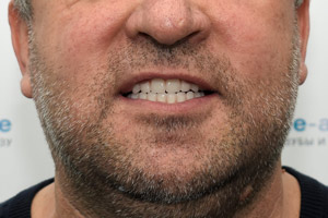 Новые зубы на верхней и нижней челюстях за 1 день, фото после