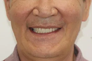 All-on-4 на обе челюсти для пациента из Якутии, фото после