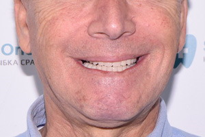 Новые зубы для пациента из г.Нальчик, фото после