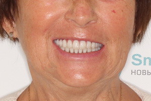 Восстановление зубов с опорой на новые и старые импланты, фото после