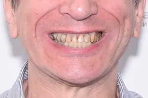 All-on-6 для обеих челюстей, плюс скуловые импланты для верхней челюсти, фото до