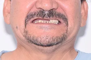 Скуловая имплантация для восстановления зубов. Протокол All-on-6, фото до