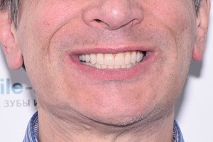 All-on-6 для обеих челюстей, плюс скуловые импланты для верхней челюсти, фото после