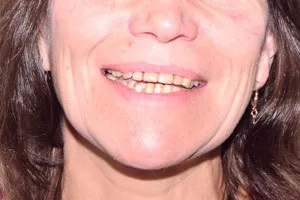 Восстановление обеих челюстей с применением скуловой имплантации, фото до