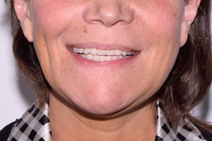 Восстановление обеих челюстей с применением скуловой имплантации, фото до
