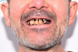 All-on-6 на смену разрушенным зубам, фото до