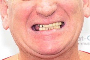 Комплексное восстановление зубов верхней и нижней челюсти, фото до