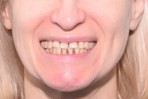 Все-на-6 на замену проблемным зубам и пародонтиту, фото до