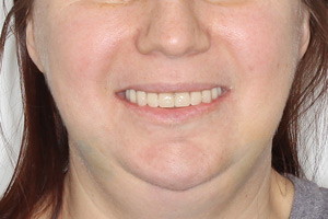 All-on-6 с двумя базальными имплантами на обе челюсти, фото после