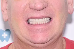 Комплексное восстановление зубов верхней и нижней челюсти, фото после