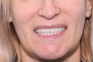 Все-на-6 на замену проблемным зубам и пародонтиту, фото после
