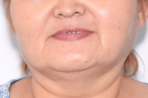 Восстановление верхней челюсти на шести имплантах
